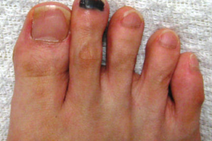 爪下血腫【ランナー黒爪】治らないのはシューズが原因？6つの予防法を紹介